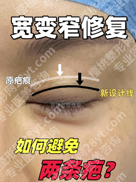 哈尔滨瑞丽整形双眼皮修复怎么样?4位王牌医生+真实案例,失败眼逆袭指南