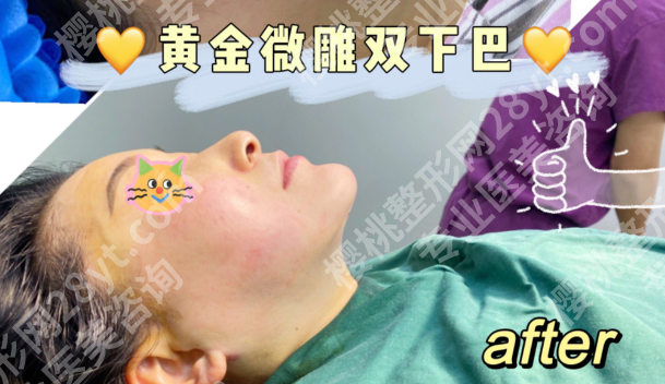 下巴黄金微雕一般多少钱？2025价格表+避坑指南，附真实案例拆解