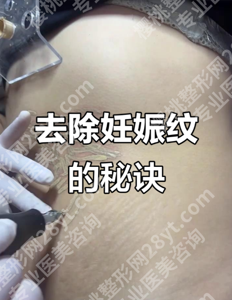 南京妊娠纹修复哪家三甲医院好?4家实力派测评+真实案例+避坑指南
