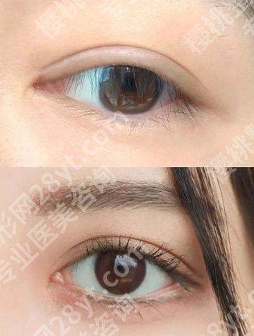 西安何林做的双眼皮怎么样?交大一附院名医+真实案例+价格,闭眼冲不踩坑
