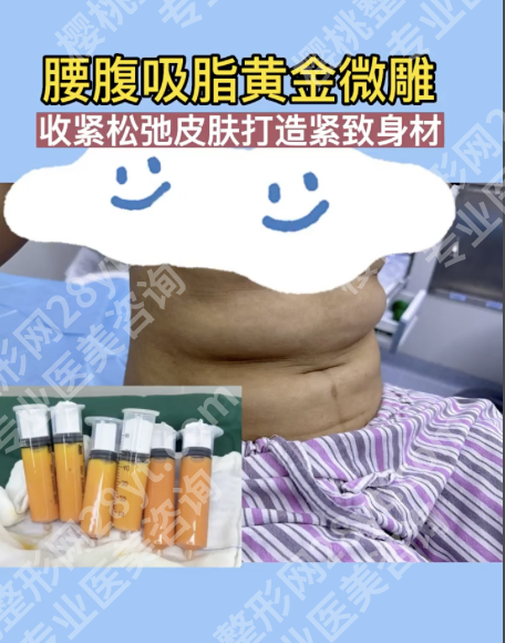 腹部黄金微雕包括吸脂吗？一篇讲透核心逻辑与实操要点