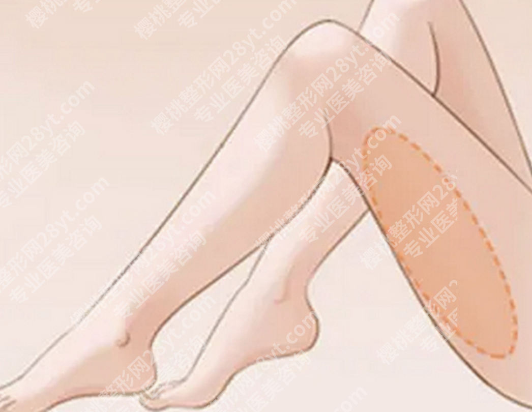 金华大腿吸脂哪家好？告别“大象腿”焦虑，选对机构是关键