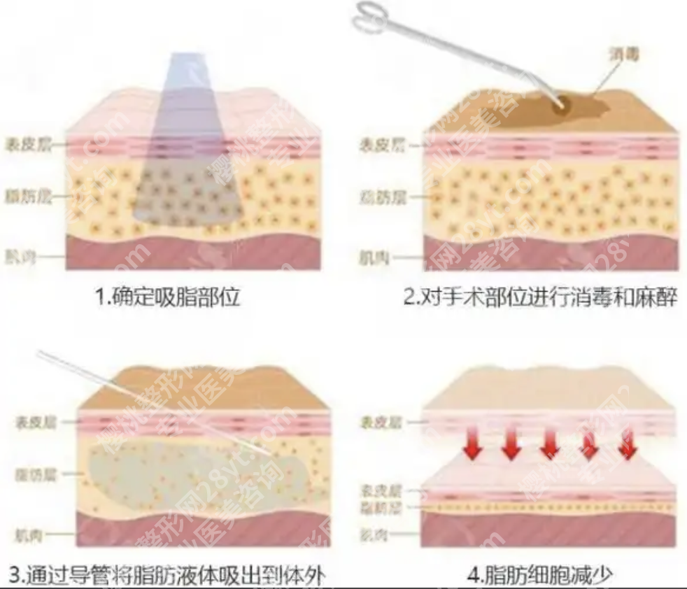 负压吸脂的操作过程拆解：从术前准备到术后恢复，干货满满不踩坑