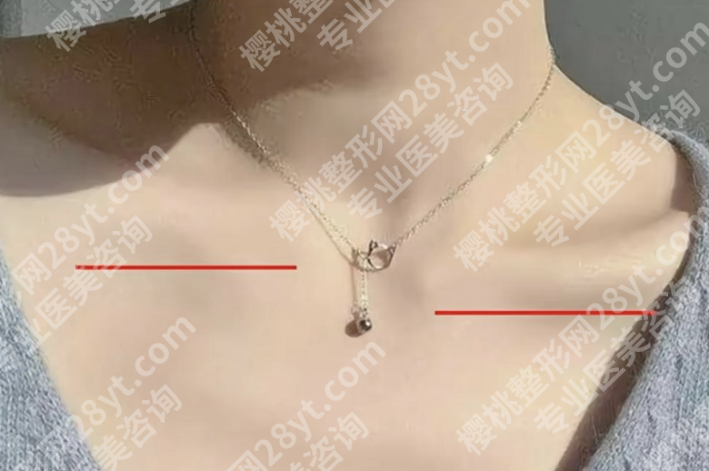 锁骨短缩矫正多少钱？一篇看懂费用、案例与性价比