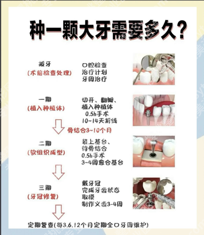 上海六院种植牙大概多少钱一颗啊?来看4个核心影响因素