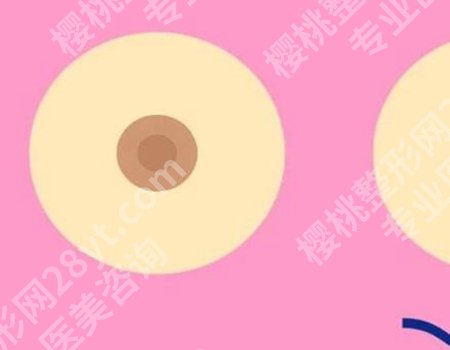 做乳晕缩小手术的利弊在哪？详细利弊这里有