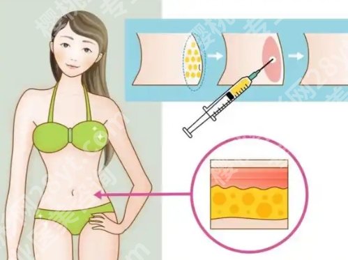 负压吸脂的优缺点，效果维持时间、风险点与适合人群一次说清