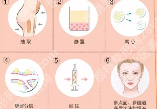 上海九院做脂肪填充好的医生有哪些？杨娴娴，魏皎，周显玉口碑好