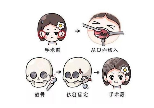上海九医院做下颌角手术好吗？好，医生专业，轻松变美不花冤枉钱！