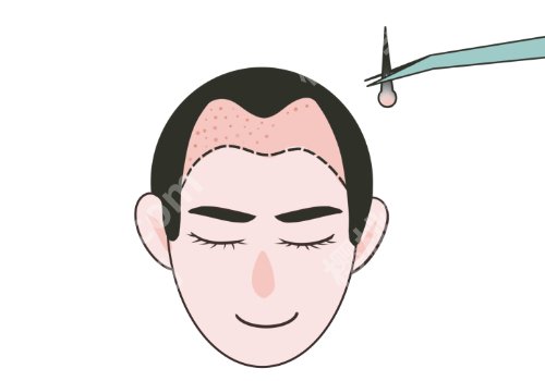有在西京医院做过植发的吗？有！案例丰富、性价比高