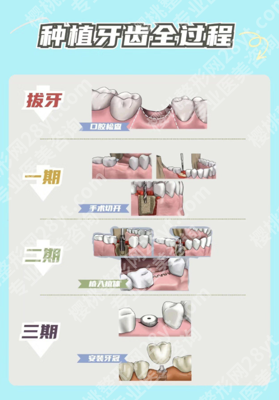 深圳北大医院种牙怎么样？选对医院，少花2万+少遭3遍罪