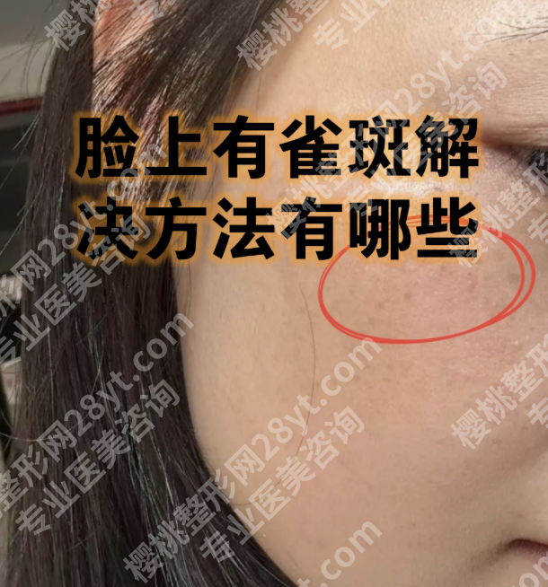 浙二医院去雀斑怎么样?谨防“认知陷阱”,解密“破局之道”