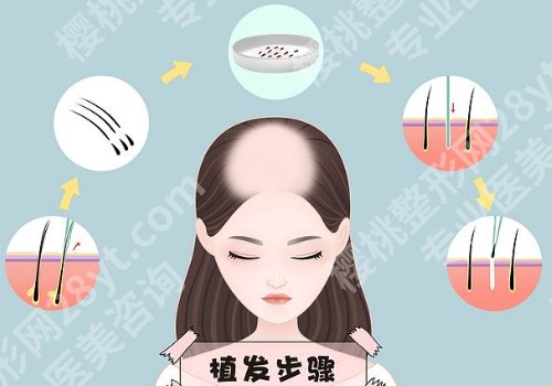 西京医院植发价格一览表公开!医生信息、常见问题一览