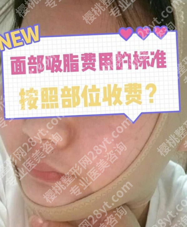 山东省立医院面部吸脂价格出炉，3个核心变量决定你要花多少钱