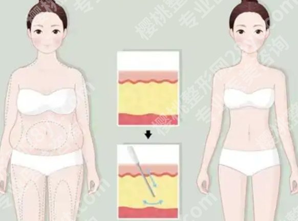 北京八大处吸脂好的医生？根据腰腹、大腿、手臂等不同部位推荐合适医生