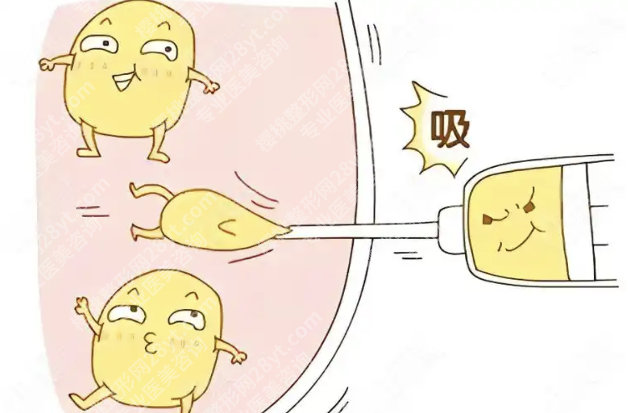 北京301医院吸脂做得好吗？特色技术不止是“吸”，更是“精雕”