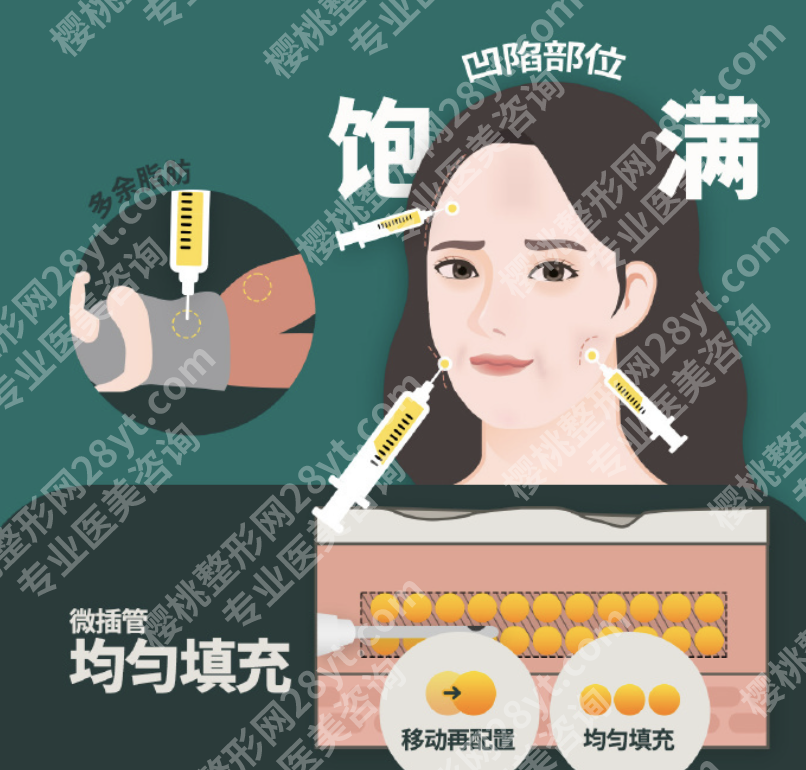 上海哪个医院做脂肪填充好？选医院，这3个硬指标别忽略