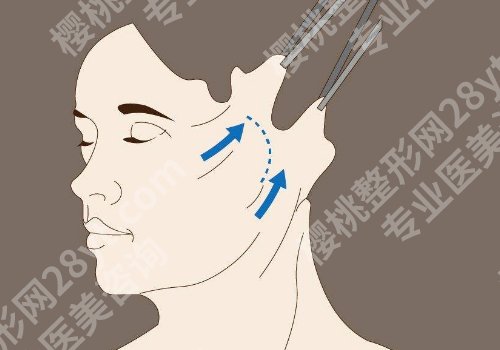 八大处拉皮手术谁做的好？赵延勇、侯典举、杨庆华医生优势、真实体验分享