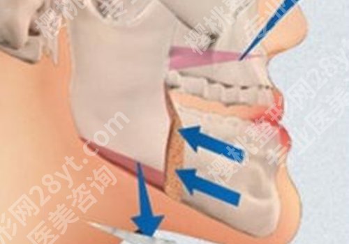 上海九院正颌手术做的怎么样?准确解决骨性难题、优势+价格双公开