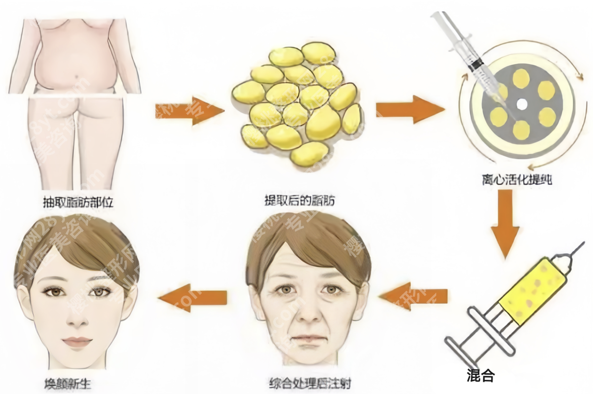 北京三甲医院脂肪填充全攻略：安全塑美，自然焕新不踩坑