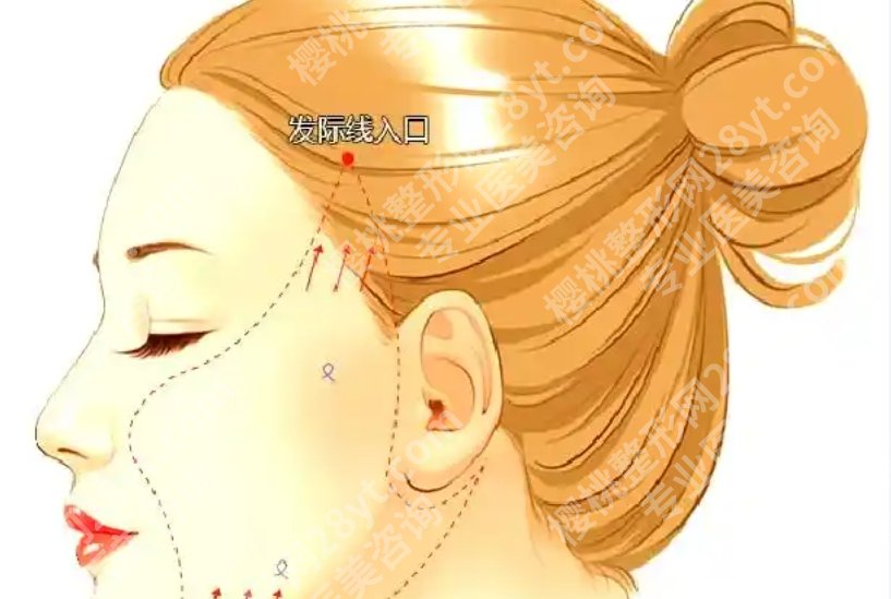 北医三院拉皮手术多少钱?项目组合与住院相关花费说明