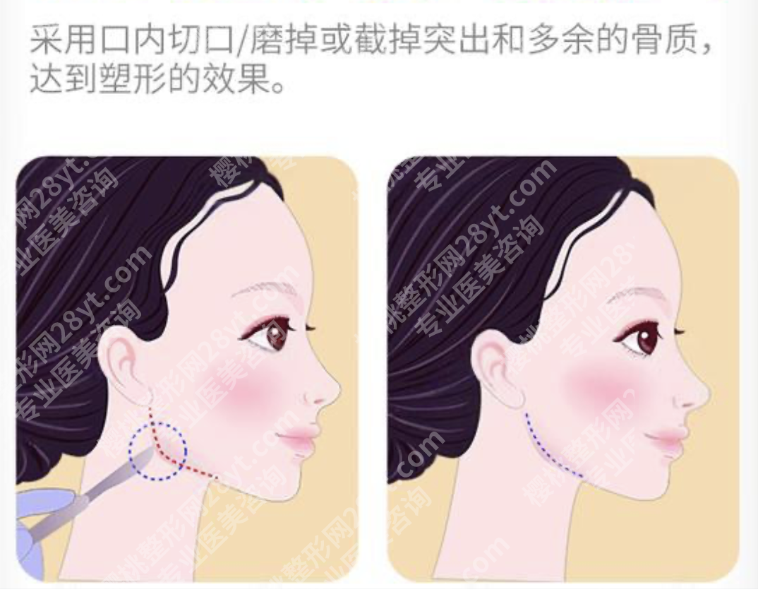 杭州哪家医院可以做下颌角整形术？这几家真靠谱