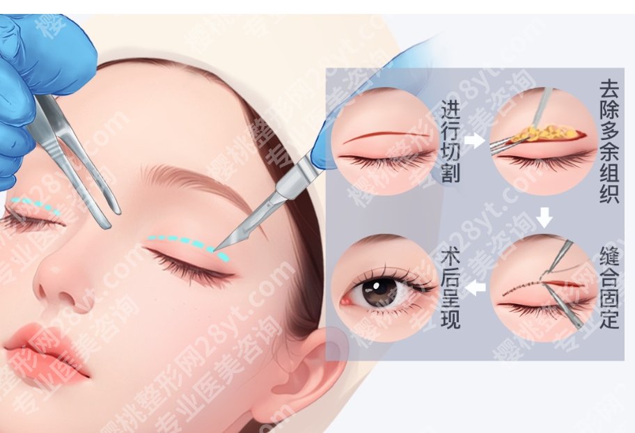 深圳北大医院双眼皮价格，附价位区间 + 影响收费的关键因素