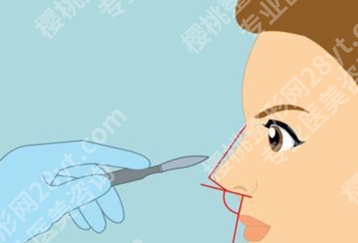 山东省立医院假体隆鼻多少钱？不同假体价格区间参考
