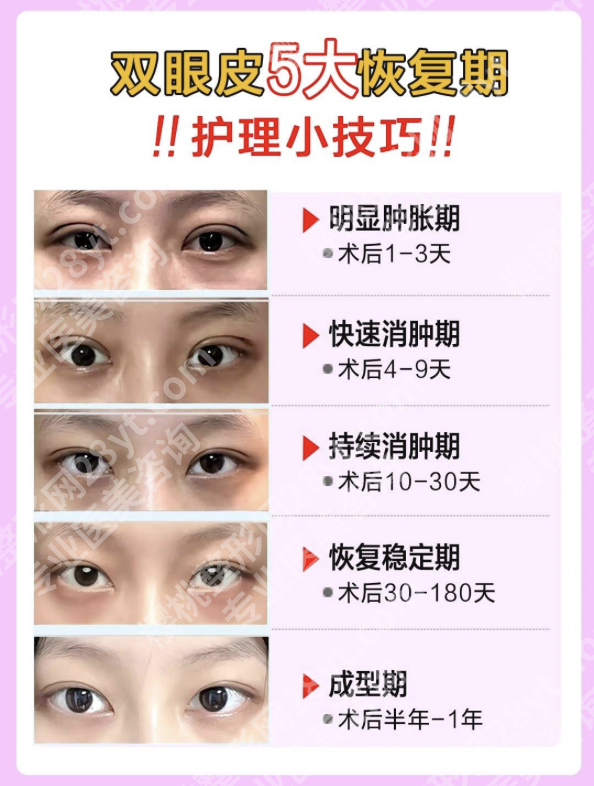 深圳北大医院割双眼皮怎么样？医生、价格、案例全揭秘