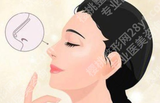 吉大一院隆鼻多少钱？假体、自体肋软骨不同价格档位解析