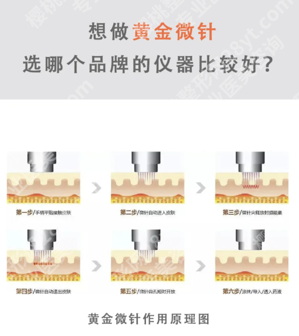 杭州市三医院黄金微针价格分析：按疗程购买划算