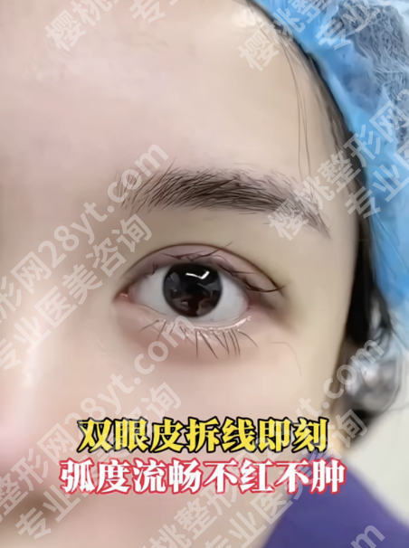 南方医院割双眼皮怎么样？真实反馈+性价比全拆解