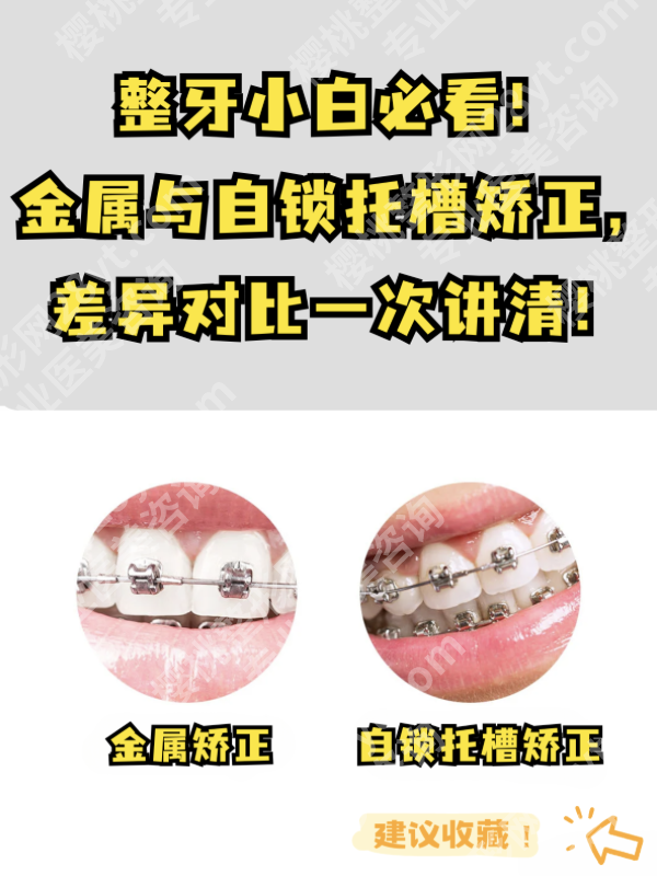 浙二矫正牙齿好还是省口好?正畸两大王牌全维度实测对比