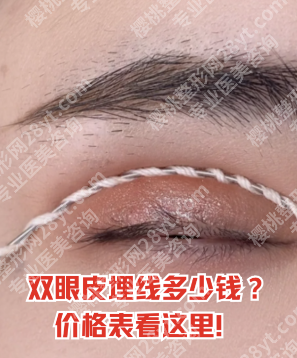 华西医院双眼皮埋线多少钱?从线材选择看价格分层