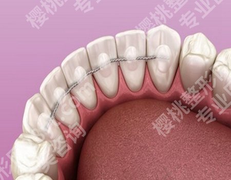 北京301医院矫正牙齿多少钱？正畸费用明细全解析