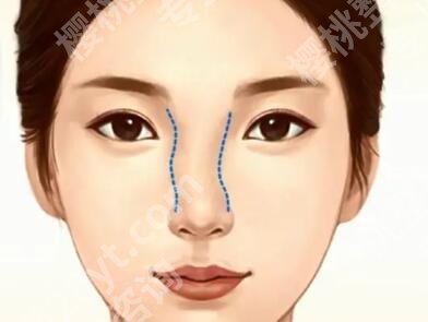 北医三院鼻整形价格是多少？鼻整形价格为13056元起
