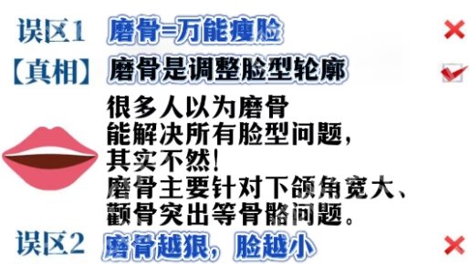 深圳北大医院磨骨怎么样?精准轮廓重塑的选择!