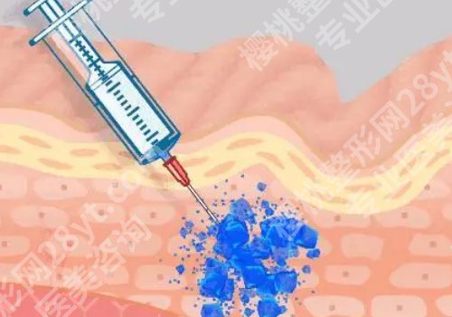 上海九院打玻尿酸哪个医生好？杨娴娴、苏薇洁、姜陶然准确拿捏层次用量