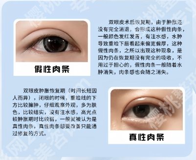 南方医院双眼皮手术收费贵吗？医院资质正规实力强！附价格表