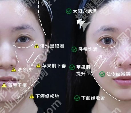 安徽省立医院脂肪填充颧骨凹陷要多少钱?安全吗?注意事项盘点