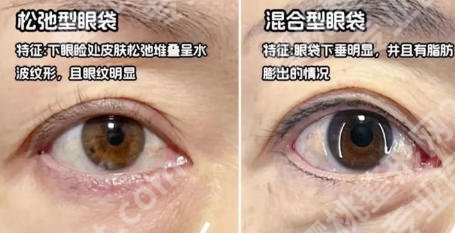 山东省立医院去眼袋哪个医生技术好些?各大专家资质对比!