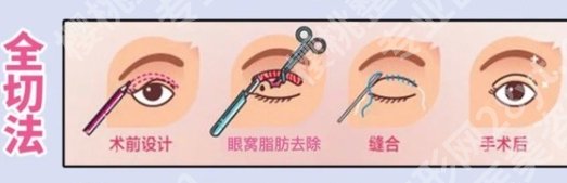 浙医二院割双眼皮多少钱？全切、埋线、多点等方式费用有所区别！