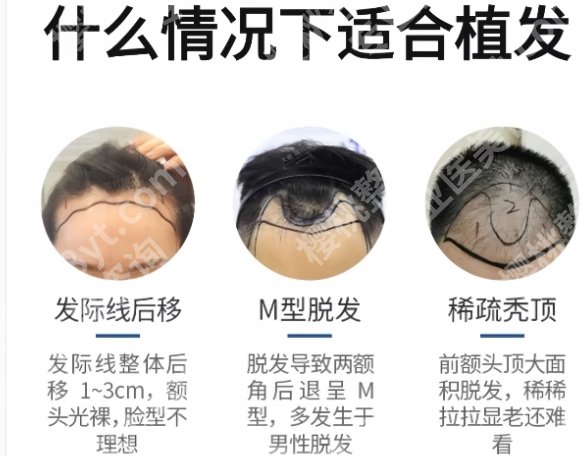 成都华西植发怎么收费的?价格贵不贵？细节展示！