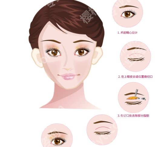 深圳北大医院埋线双眼皮多少钱？3952元起|戳戳看案例