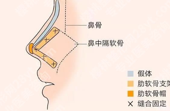 北医三院整鼻子怎么样？内附真人做隆鼻项目全流程！
