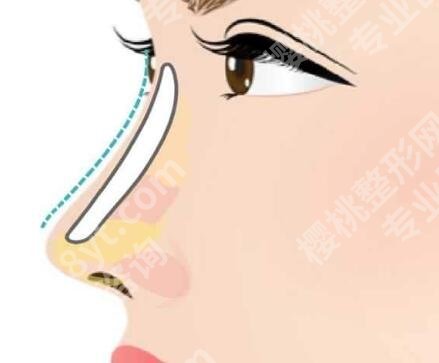 中山做鼻子好的医生排名有哪些？5位真人实测款
