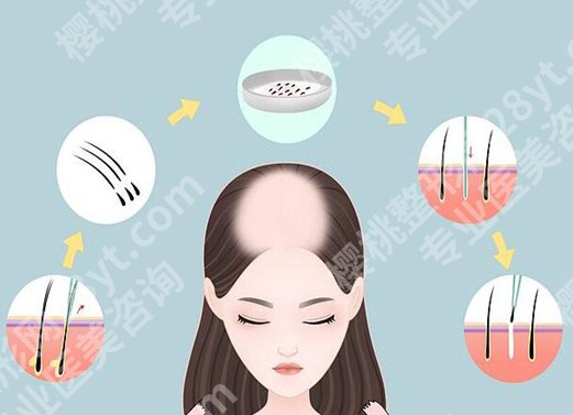 山东省立医院植发专家有哪些？严选人气医生，参考价格赶紧看