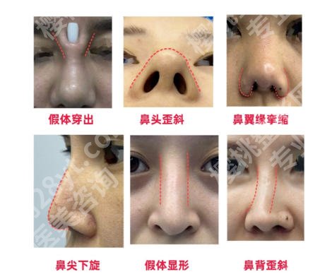 哈尔滨鼻修复出名的医院有哪些？五家医院个个 实力派！