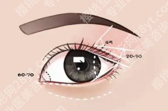浙江二院割双眼皮怎么样？医生风格和口碑体验先看看