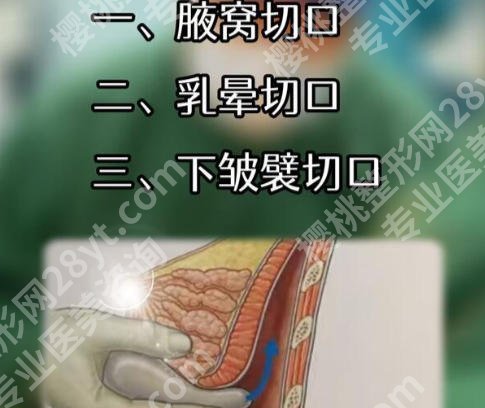 湘雅二医院丰胸手术费用公布！低至4w起含王先成等技术高超的医生！
